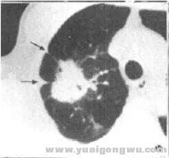 胸膜凹陷征