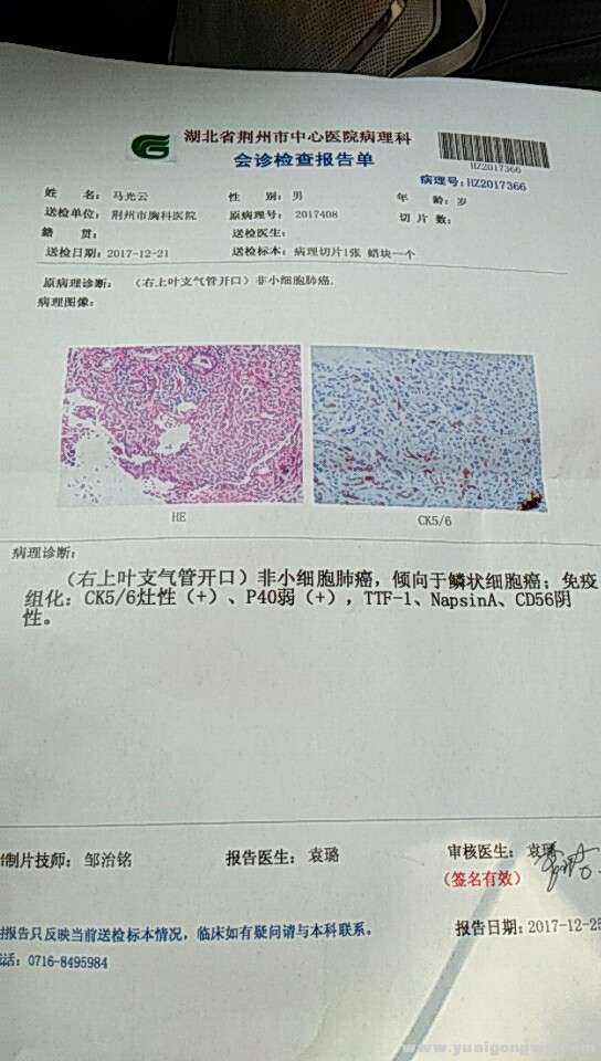 非小细胞肺癌（鳞状细胞癌）.jpg